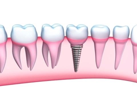 Dental Implant